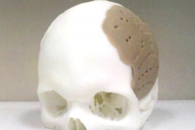 Пацієнту надрукували черепну коробку на 3D-принтері