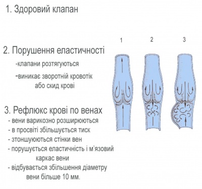 Сучасні методи лікування ВАРИКОЗУ в МЦ «Оксфорд Медікал Чернівці» (на правах реклами)