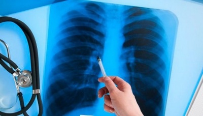 Щороку у Чернівецькій області від туберкульозу помирає 50 людей