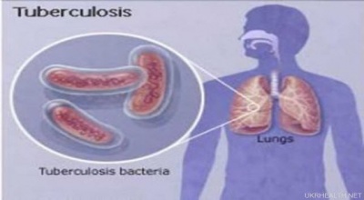 Медики перерахували ранні симптоми туберкульозу