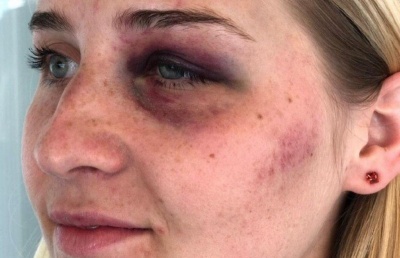 Побиття дівчини у Чернівцях: у мережі оприлюднили фото ймовірного нападника