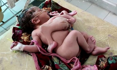 В Індії народилася дитина з 3 руками та 4 ногами