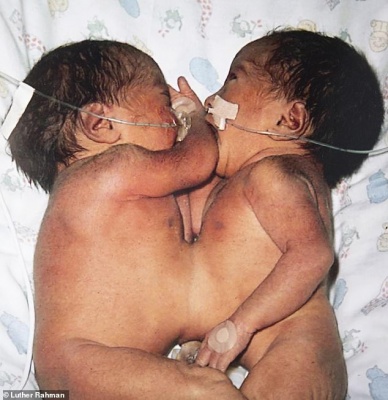 Сіамські близнюки в Україні: де народжувались, і яка їхня доля