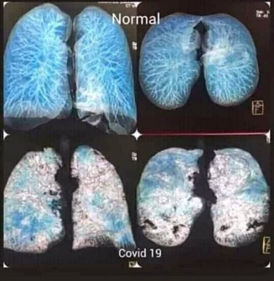 Українські медики показали фото уражених коронавірусом легень