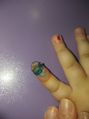 У Чернівцях хірурги приживили фалангу пальця 3-річній дівчинці